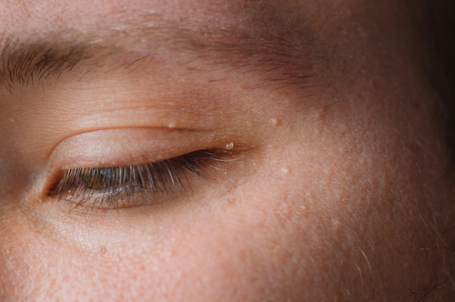 Skin Cancer To Eyelid Infection: 5 Dangerous Gel Nail Polish Side