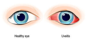 Uveitis Manchester | Eye Inflammation Nashua | Medical Eye Center